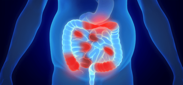 Mastering Inflammatory Bowel Disease